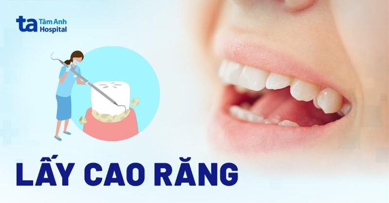 Hinh anh minh hoa qua trinh lay cao rang lam sach mang bam den tai phong kham nha khoa